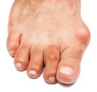 Charlotte Podiatrist | Charlotte Bunions | NC | Charlotte Foot & Ankle Specialists |